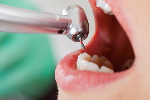 Best Emergency Dental Extractions in New Carlisle, IN